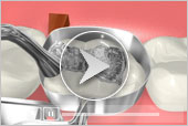 Amalgam (Silver Fillings) Pediatric and Adult Dentistry