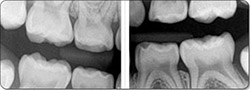 Adult Dentist Tooth X-Ray